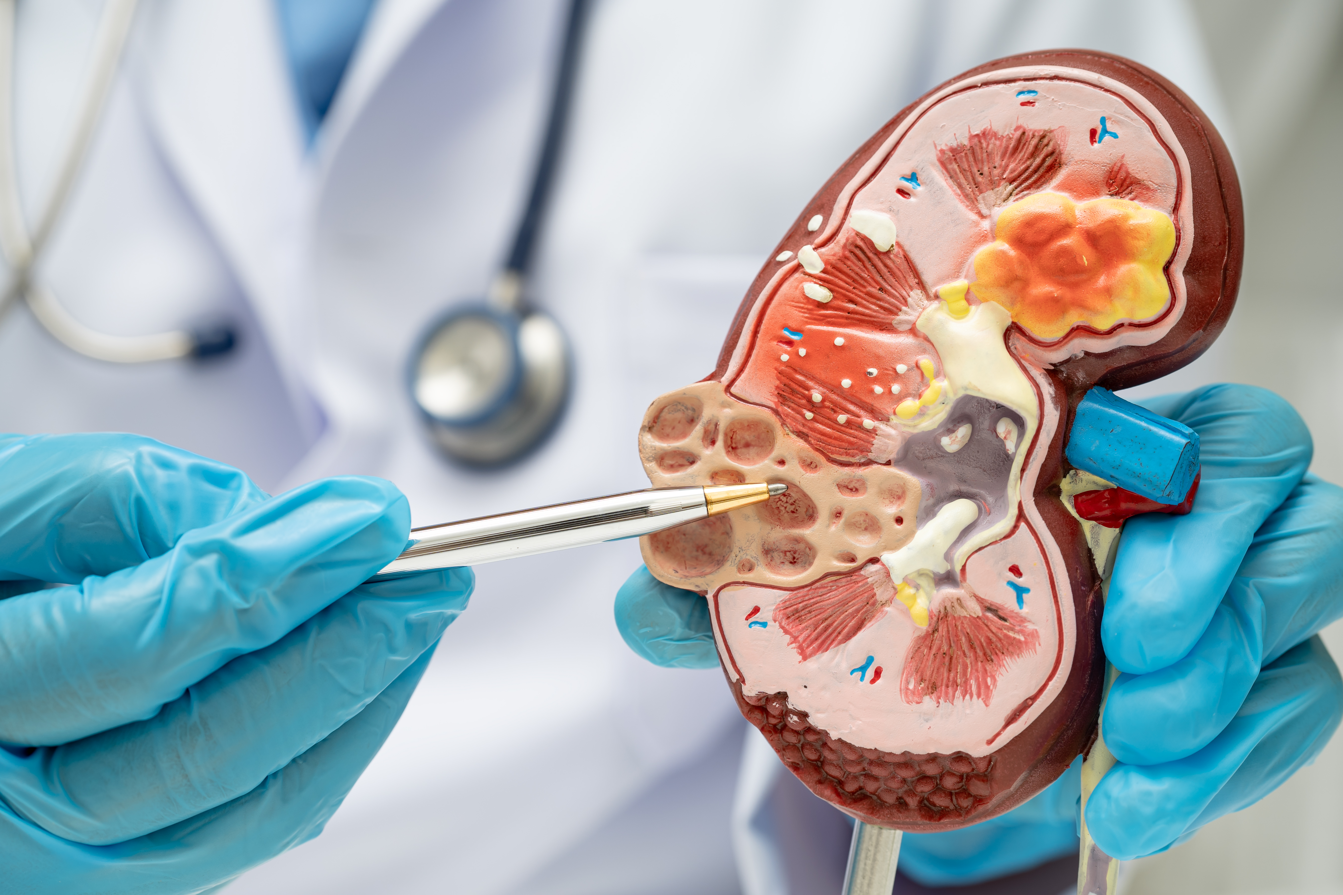 Kidney Doctor Nephrologist: Your Kidney’s Lifeline