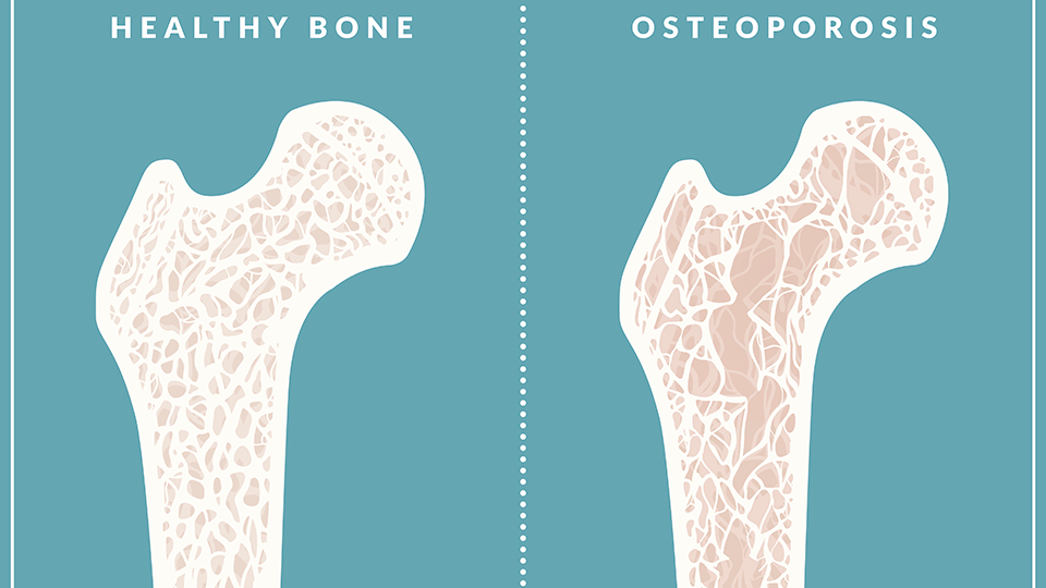 Oct. 20 Is World Osteoporosis Day