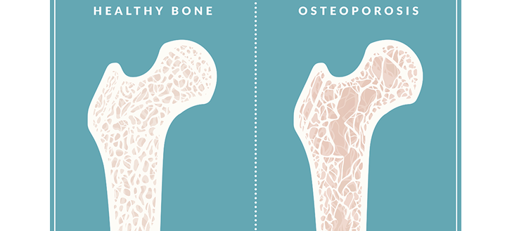 Oct. 20 Is World Osteoporosis Day