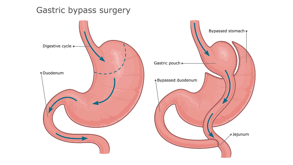 Illustration of a gastric bypass