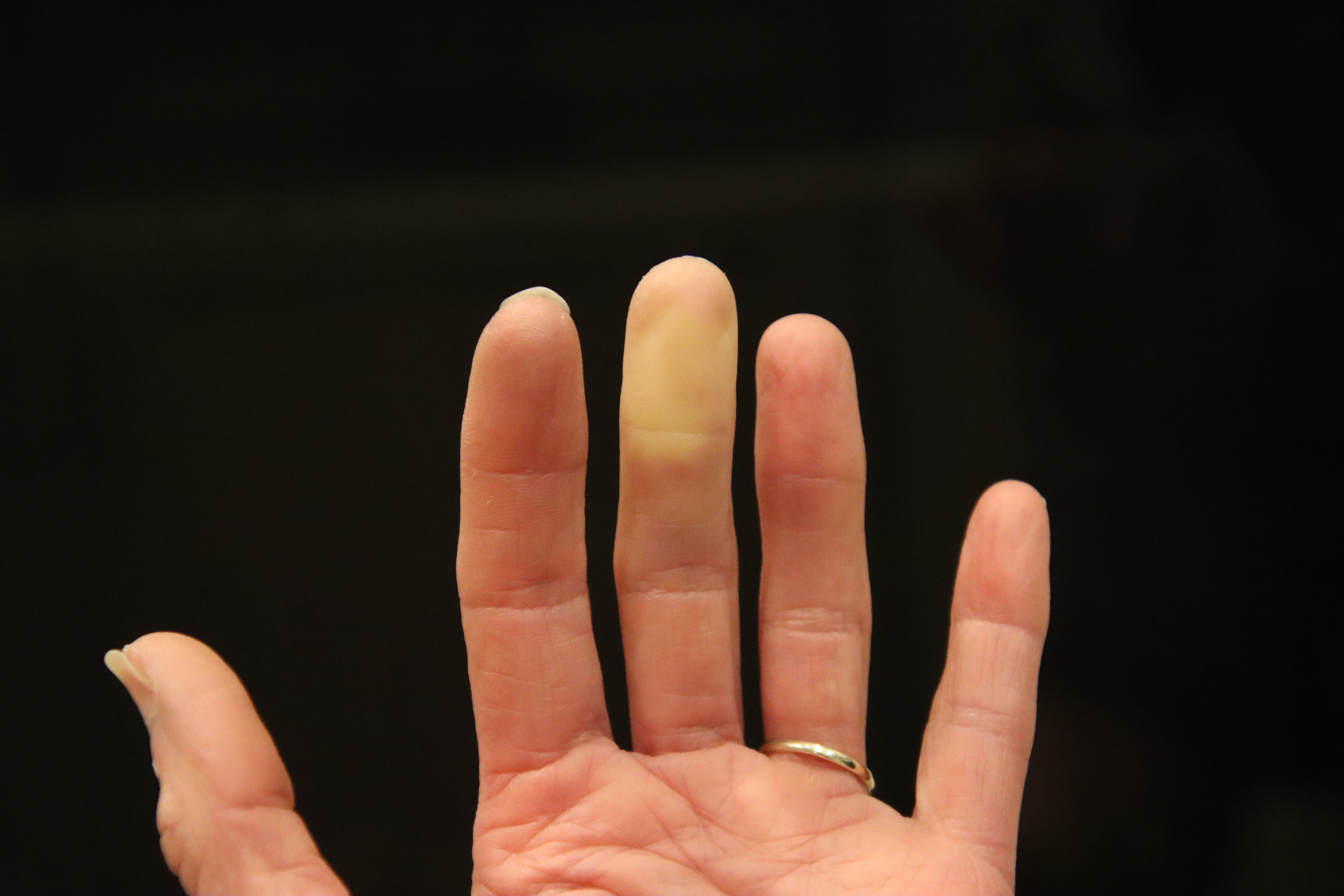 a hand is shown where the tip of the middle finger has turned a pale, white color that's characteristic of Raynaud's