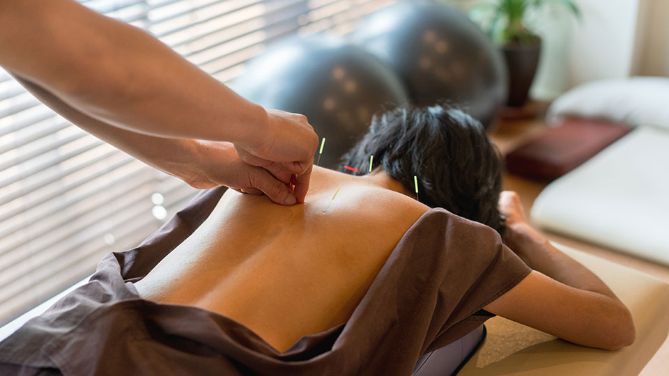 Woman getting acupuncture